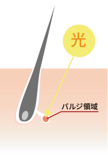 SHR脱毛とは