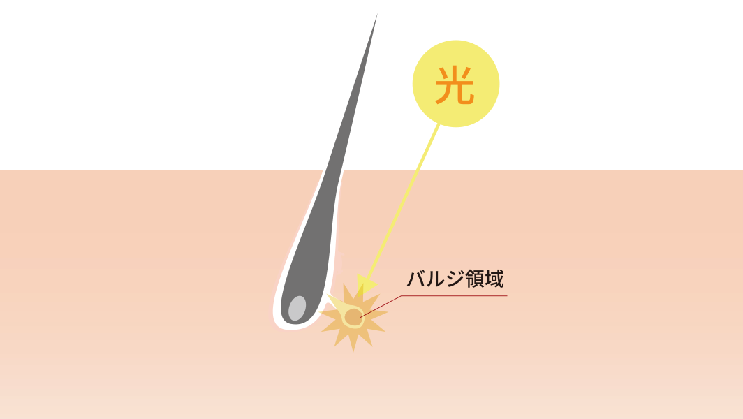 SHR脱毛とは
