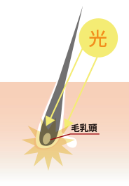IPL脱毛とは