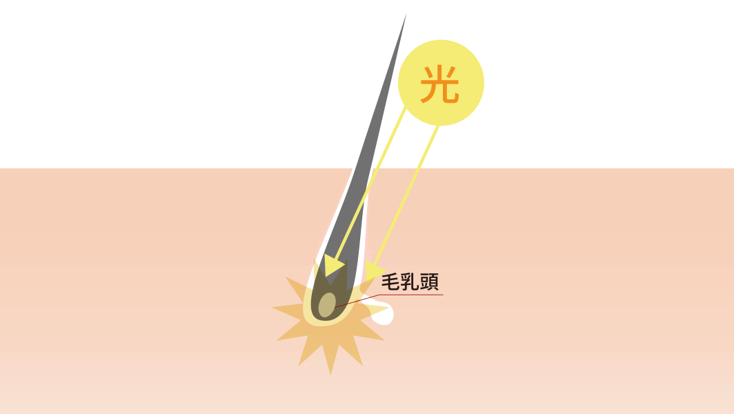 IPL脱毛とは
